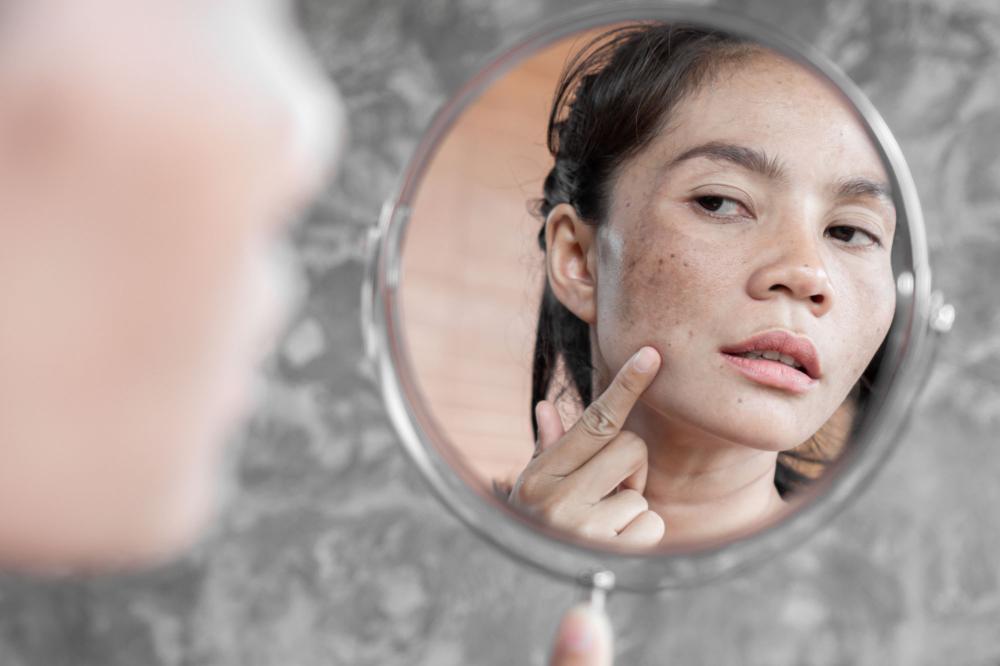 peeling-acne