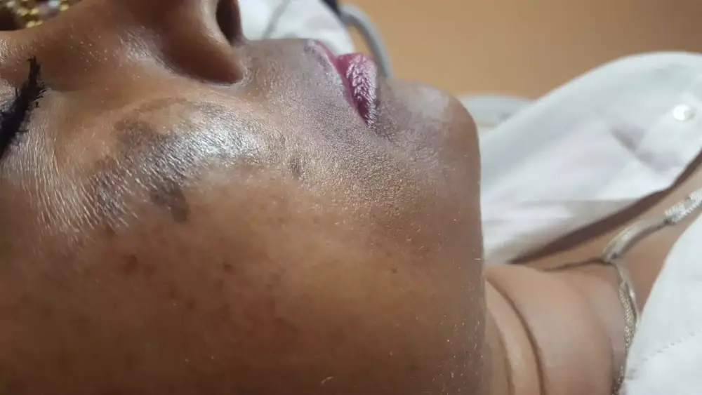 Avant-peeling-taches