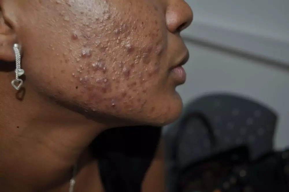 Avant-peeling-acne