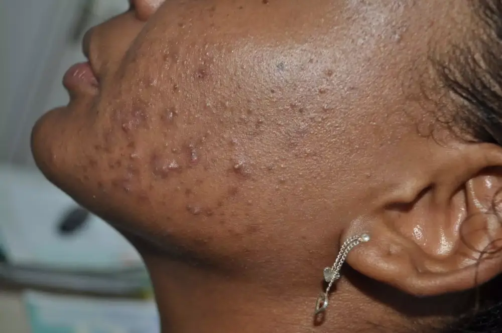 Apres-peeling-acne