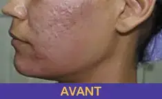 acne-1