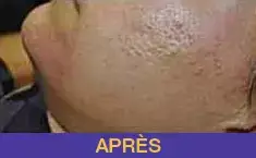 acne-2