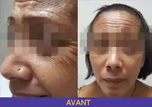 botox-1