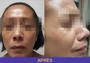 botox-2
