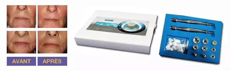 microdermabrasion