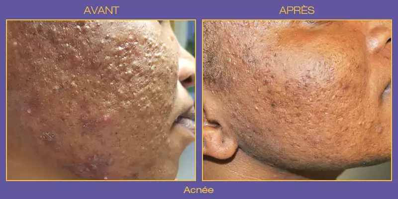 acne-avant-apres