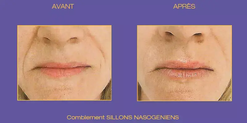 sillons-nasogeniens