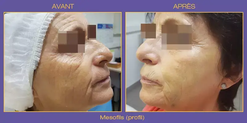 mesofils2