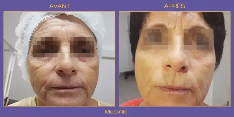 mesofils
