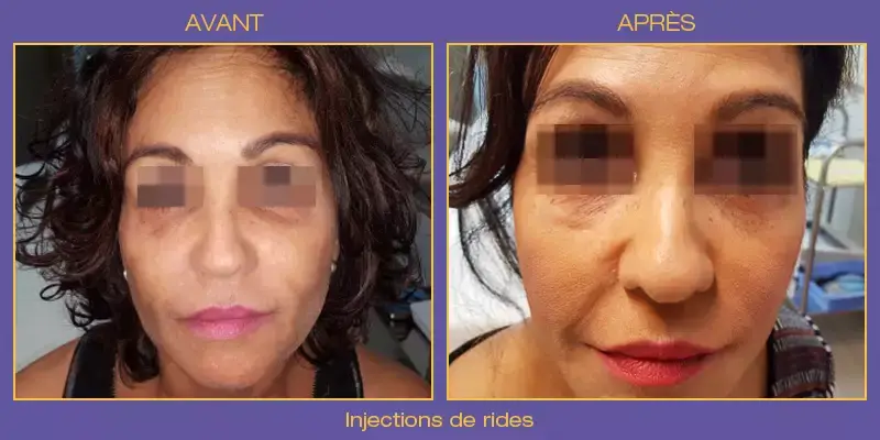 injections-rides2