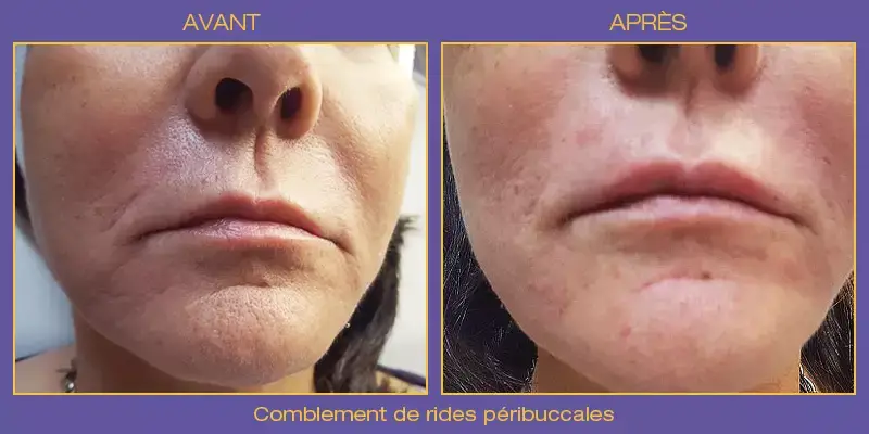 injections_peribuccales