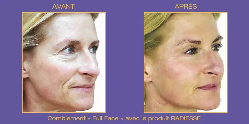 fullface