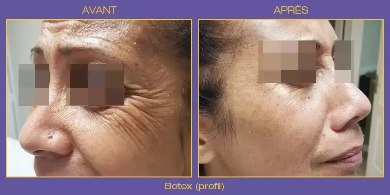 botox