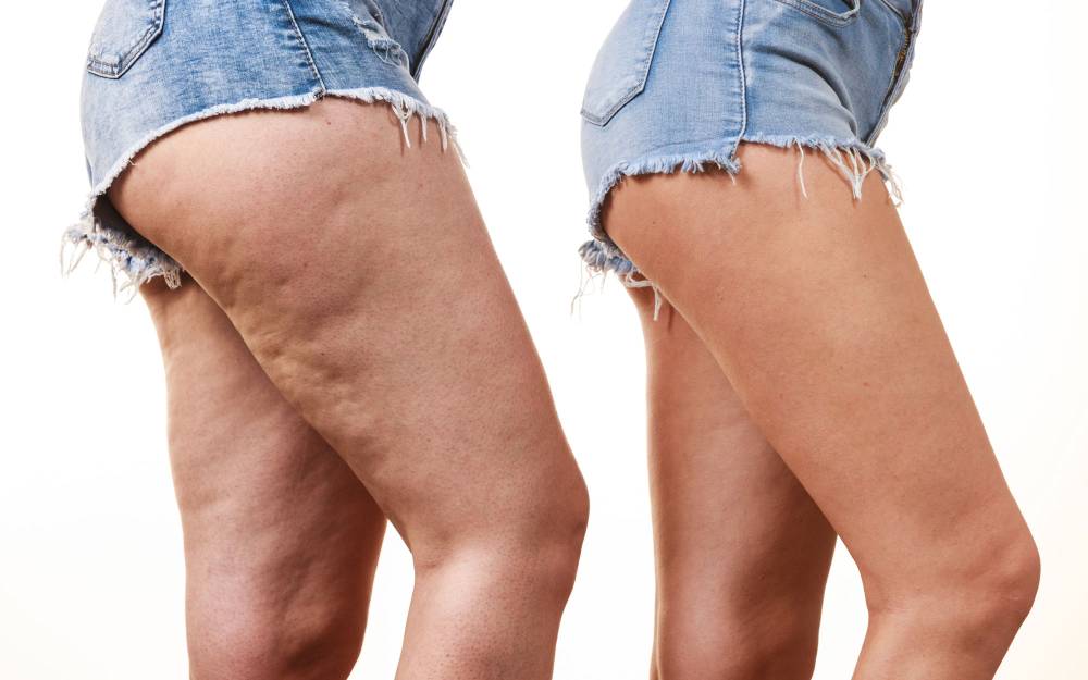 Cellulite à Sainte-Marie